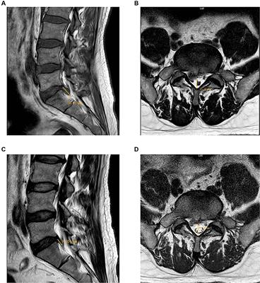 Case report: Spontaneous regression of extruded lumbar disc herniation with acupuncture therapy